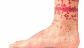 Bloom bites jaké parazity kousají lidi, jak kousnutí vypadají jako nebezpečné pro lidi!